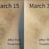 In just a few treatments you'll start noticing results*. Https Encrypted Tbn0 Gstatic Com Images Q Tbn And9gcqqpqv3jigzewpnfhctjzw3ft3bq72dcnywmwbquvsvz3kd5g1a Usqp Cau