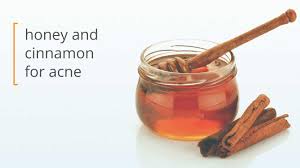 using honey and cinnamon for acne