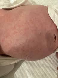 Image result for dermatitis contacta toxica