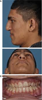 The Clinical Application of Recombinant Human Bone Morphogenetic Protein 7  for Reconstruction of Alveolar Cleft: 10 Years' Follow-Up