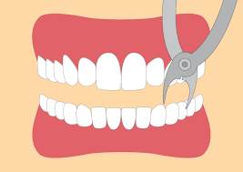 Bei der entfernung eines zahns (in der wann sie sich an ihren zahnarzt wenden sollten: Zahn Ziehen Alles Was Sie Wissen Mussen 360 Zahn
