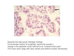 Schau dir angebote von ‪orphan annie‬ auf ebay an. Endocrine Pathology Case 3 55 Year Old Woman Presents For An Annual Physical Exam A Painless 2 5 Cm Nodule Is Palpated In The Left Thyroid Gland There Ppt Download