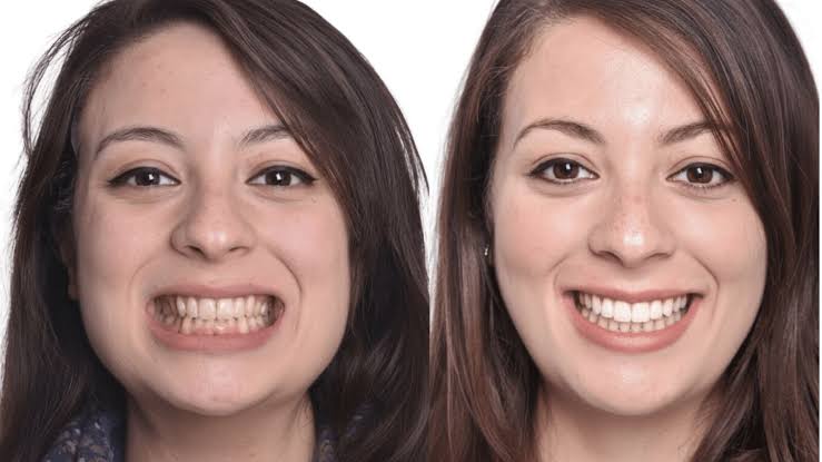 Flat Smile Arc | World Orthodontics