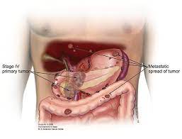These include pancreatic cysts or pancreatitis. Advanced Cancer Pancreatic Cancer Action Network