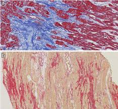 The 53rd baeksang arts awards. A Image Of A Heart Tissue Stained With Masson Where Fi Brosis Is Download Scientific Diagram