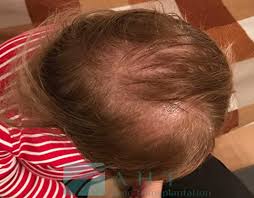 Diffuse alopecia is a condition in which the hair on the head thins out. Androgenic Alopecia