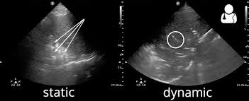 Image result for Air Bronchogram