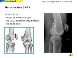 Medial condyle is convex medially. Distal Femur Fracture