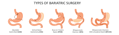 lose weight after bariatric surgery