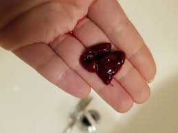 Some miscarriages happen very early, even before a woman is sure she is pregnant. Miscarriage Tissue 8 Weeks