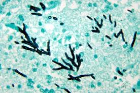 Mucormicosis rinocerebral en paciente con cefalea y diabetes mellitus. Pin On Purificacion De Aire