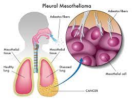 Asbestos fibers may take decades to cause cancer growth within the body&#x27;s organs. Mesothelioma Pain And Suffering Damages Awards Affirmed New York Injury Cases Blog