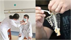 Ulang sebanyak 3 kali sehingga 7 kali. Duri Ikan Nyangkut Di Tenggorokan Segera Lakukan Cara Cepat Dan Efektif Ini Untuk Melepaskannya Semua Halaman Grid Health