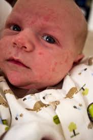 Known as newborn rash, it usually shows up on the second day after birth, though it can be present at birth or appear within the first. My Newborn Has A Rash Should I Worry My Two Hats