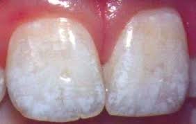 Fluorosis Stains On Teeth Cosmetic Dentistry
