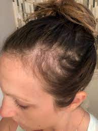What causes postpartum hair loss? How To Quickly Cover Bald Spots During Postpartum Hair Loss Just Simply Mom In 2021 Postpartum Hair Loss Hair Stules Bald Spot