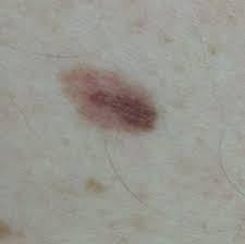 Pictures reveal your cancer risk. Skin Cancer Pictures Includes Moles And Other Skin Spots