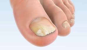 Agentii care cauzeaza aparitia acestei ciuperci sunt trichophyton mentagrophytes ce cauzeaza tip vezicular si interdigital de ciuperca si trychophyton rubrum ce. Tratment Naturist Micoza Unghiei Danihilldesign Com