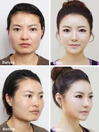 South korea's dangerous ghost doctors are putting plastic surgery patients' lives at risk. South Korean Plastic Surgery Craze Blamed For Creating Look Alike Miss Korea Pageant Contestants