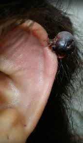 'people with risk for getting keloids are. Diy Removal Of Skin Blemishes Puts People At Risk Of Death Express Digest