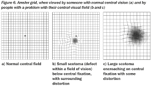 community eye health journal visual field testing for