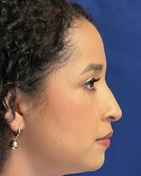 RINORECONSTRUCCION, resultado, apenas 12 días después de su cirugía.