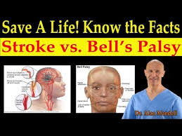 Request an appointment at mayo clinic Save A Life Know The Facts Of Stroke Vs Bell S Palsy Natural Remedies Dr Alan Mandell D C Youtube