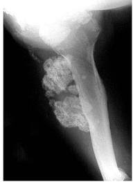 With osteosarcoma, cancerous cells produce bone, generally in the bones of the arm or leg. Osteosarcoma Physiopedia