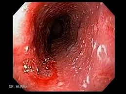 Esophagitis caused by cmv infection, most commonly occurring in patients with immunocompromise1,2,3. Endoscopy Of Infectious Esophagitis Youtube