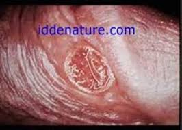 Maybe you would like to learn more about one of these? Penyakit Sipilis Pada Kelamin Pria Obat Sipilis Untuk Pria