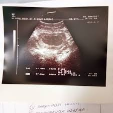 Bagian daun dan batangnya merupakan sumber alkaloid dimeric, vinacristine, dan vinblastine yang adalah bahan obat kanker yang sangat penting. Pengalaman Keguguran Takut Kena Cuci Rahim Blog Abah Careno