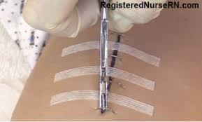 Keep the area completely dry for 24 to 48 hours after staples are placed. How To Remove Surgical Staples