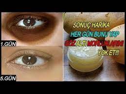 5 Gun Goz Alti Morluklarina Patatesi Boyle Kullan Koyu Halkalari Yok Et Goz Kirisikliklarini Gider Youtube Dogal Cilt Cilt Bakimi Bitkisel Tarifler