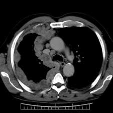 We did not find results for: Pleural Mesothelioma Eurorad