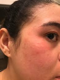 Feeling heartbeat after explant surgery