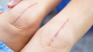 Glue or tape strips will fall off on their own over time. Healing Your Scabs After Surgery