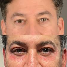 Reducing lumps after blepharoplasty surgery?