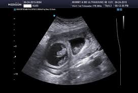 Pin De Yulieth Ortiz En Ecografia Ecografia De Gemelos Imagenes De Ultrasonido 8 Semanas De Embarazo