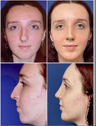 Rhinoplasty Surgery Center of Chattanooga