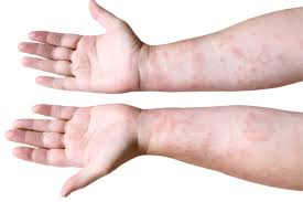 Image result for Secondary Syphilis