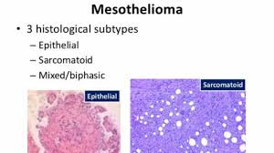 Under a microscope, sarcomatoid tissue. Sarcomatoid Mesothelioma Mesothelioma Cancer