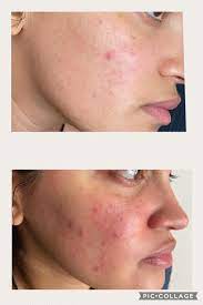 While it has been reported that topical ivermectin has better results than topical metronidazole for rosacea, there is a paper you oral ivermectin for rosacea a paper published by the internationa. My Results Using Ivermectin For 5 Days Rosacea