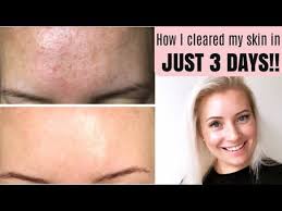 Because malassezia is normally present on our skin, dr. Get Rid Of Tiny Bumps On Forehead Fast How To Treat Fungal Acne Malassezia Being Mrs Dudley Youtube Forehead Bumps Fungal Acne Skin Bumps