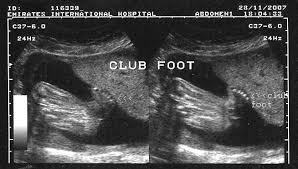 This video shows fetal anomalies, including clubfoot, encephalocele, kyphosis, and placental mass. A Gallery Of High Resolution Ultrasound Color Doppler 3d Images Fetal Spine