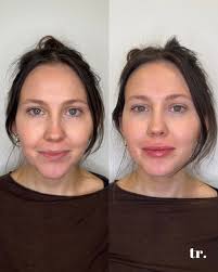 this patient is the sweetest, and her lips were the perfect canvas. I added  subtle volume, sharpened her borders, and focused