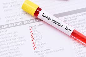 Cancer antigen 125 (ca125) is a protein found on most ovarian cancer cells that is secreted into the blood stream and can be measured. Ca125 Blood Test Useful In Diagnosing Ovarian Cancer In Routine Setting