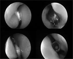 It may be secondary to chronic rhinorrhea, nose picking or viral infections. Nasal Foreign Bodies Description Of Types And Complications In 420 Cases Sciencedirect