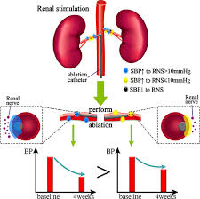 Association between calcineurin inhibitor treatment and peripheral nerve dysfunction in renal transplant recipients. Selective Renal Denervation Guided By Renal Nerve Stimulation In Canine Hypertension