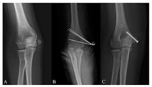 The management of displaced medial humeral epicondyle fractures in children remains controversial. Diagnostics Free Full Text Is Computed Tomography Necessary For Diagnostic Workup In Displaced Pediatric Medial Epicondyle Fractures Html