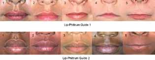 Philtrum Smooth The philtrum refers to the groove that most humans have above the upper lip. philtrum smooth